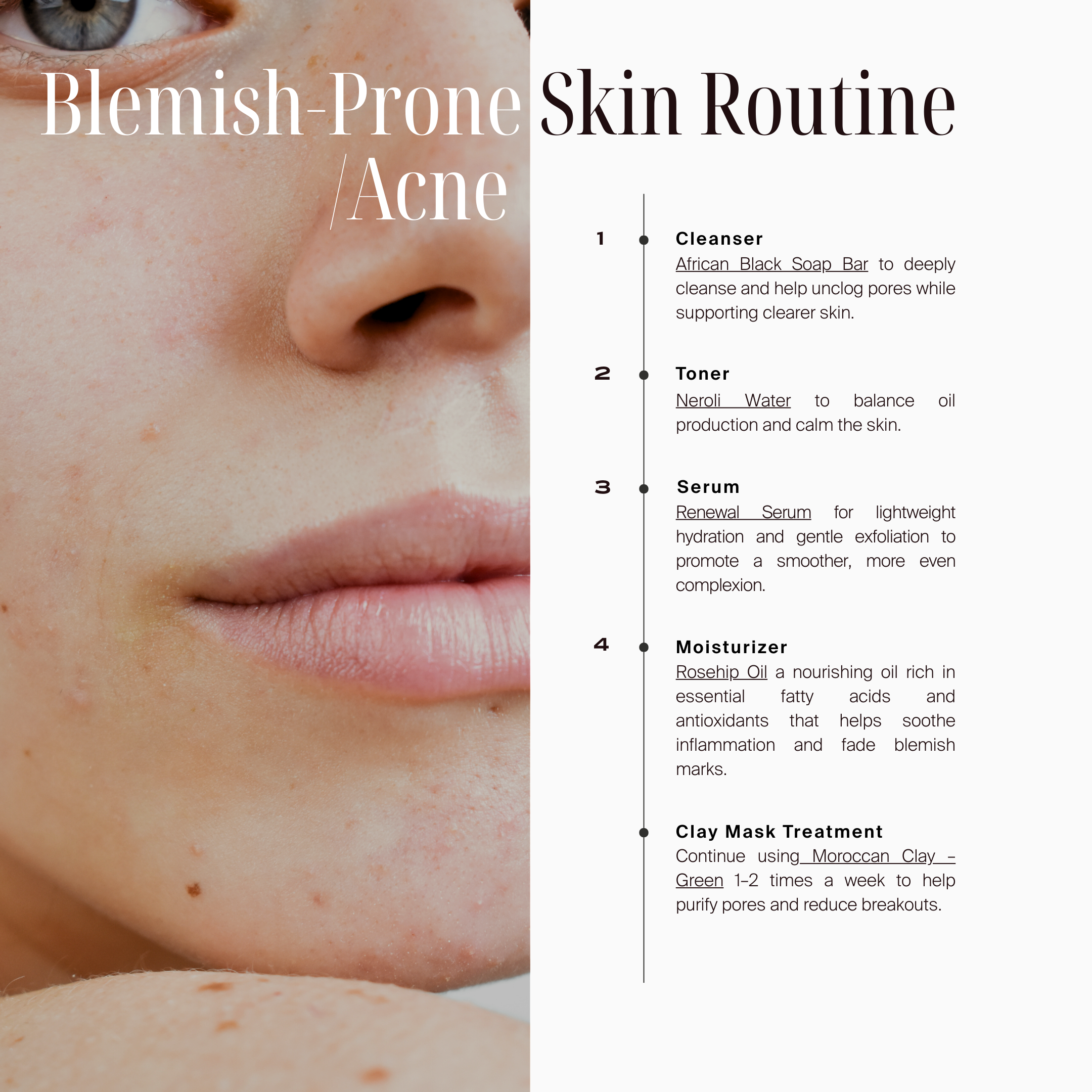 Acne or Blemish-Prone Skin - Skincare Routine