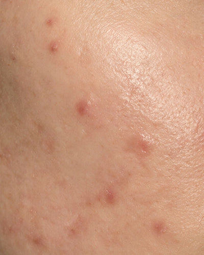 Blemish-prone skin