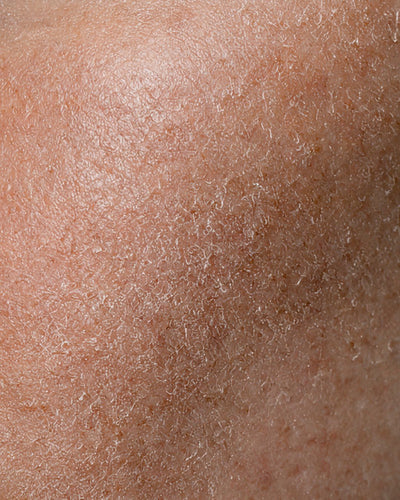 Dry skin