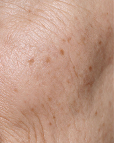 Mature skin
