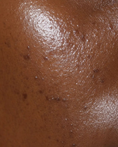 Oily skin