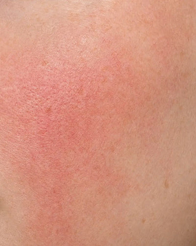 Sensitive skin